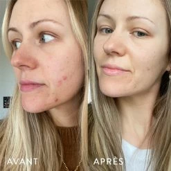 Microbiote & Peau -Dermalogica Soldes AVANT APRES LAURA.1.4jpg